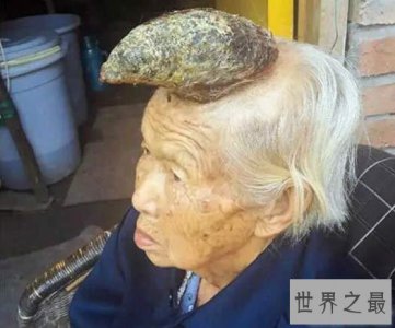 ​中国87岁老太头上长出牛角，太恐怖